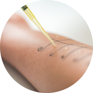 Allergologischer Hauttest in einer Hautarztpraxis: Eine Testsubstanz wird mit einer Pipette auf die markierte Haut eines Patienten aufgetragen. Typische Anwendung in Dermatologie und Allergologie zur Erkennung von Allergien.