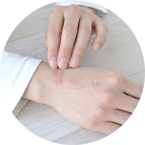 Nahaufnahme einer Hand mit einem Ekzem​ zur Behandlung bei einem Hautarzt – Fokus auf Dermatologie, berufsbedingten Hauterkrankungen und ästhetische Hautbehandlungen.