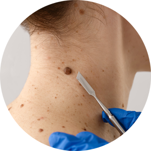 Hautarzt entfernt ein Muttermal am Nacken – Fokus auf Dermatologie, Hautkrebsvorsorge und ästhetische Hautbehandlungen in einer Hautarztpraxis für Dermatologie & Ästhetik in Leipzig.