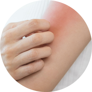 Nahaufnahme eines Hautareals am Arm mit Rötung – Fokus auf Dermatologie, Neurodermitis, Neurodermitis, Schuppenflechte und ästhetische Hautbehandlungen in einer Hautarztpraxis für Dermatologie & Ästhetik in Leipzig.