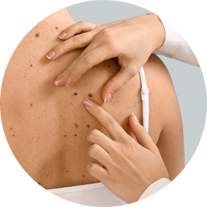 Rücken einer Person mit Muttermalen, die von einem Arzt in einer Hautarztpraxis dermatologisch untersucht wird – Fokus auf operative Dermatologie und ästhetische Hautbehandlungen in einer Hautarztpraxis für Dermatologie & Ästhetik in Leipzig.